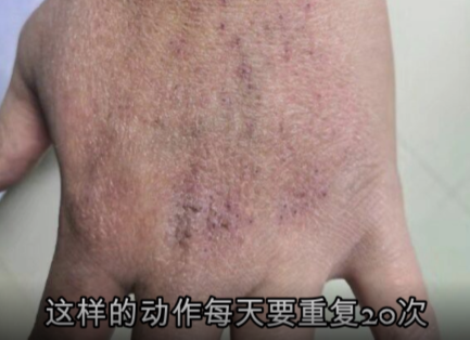 战疫先锋||溃烂的双手