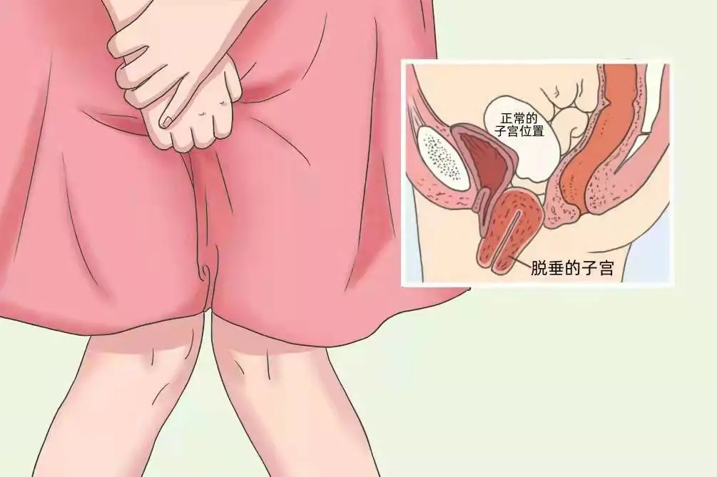 子宫脱垂改进疗法，汝城独家，服务全城