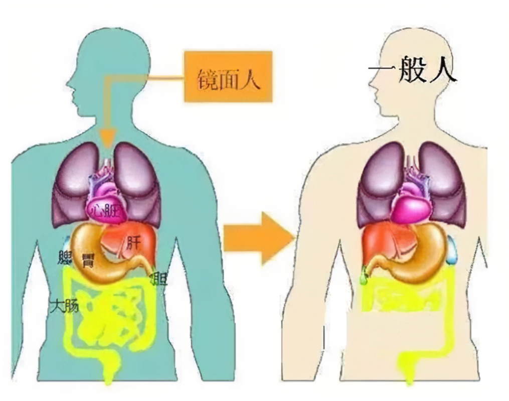汝城县人民医院为罕见“镜面人”成功实施腹腔镜胆囊切除术
