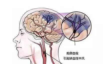 技术新突破！全县首例脑动脉支架取栓术，成功救治大面积脑梗死患者